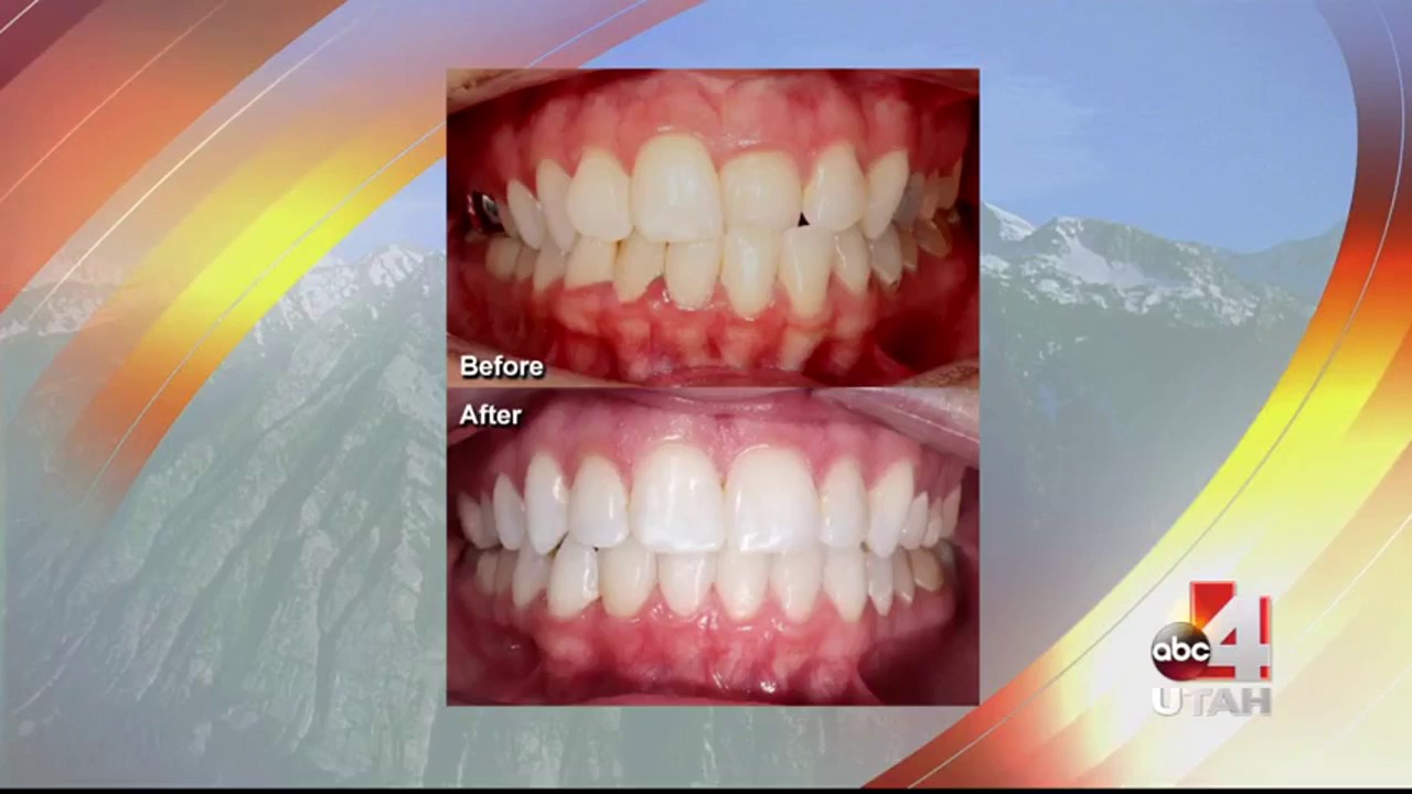 Invisalign vs. Traditional Braces for Kids