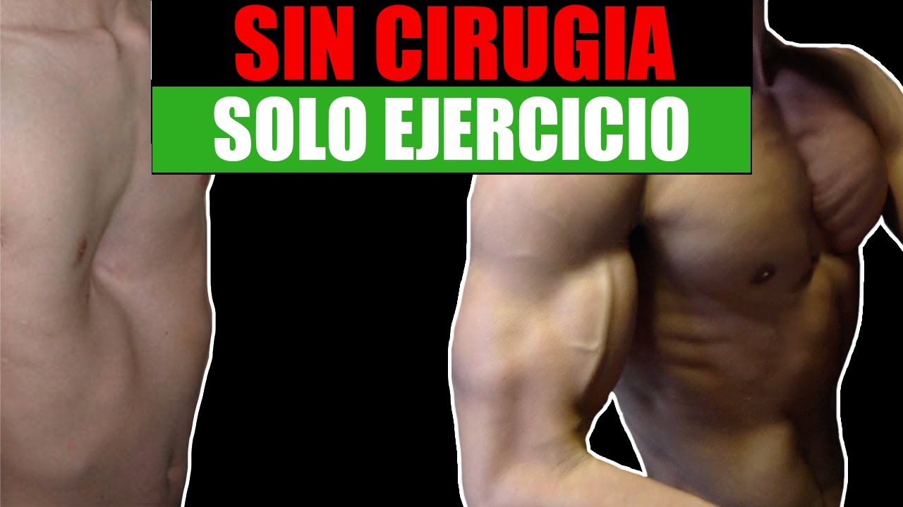 ARREGLAR PECHO HUNDIDO SIN CIRUGIAS CON EJERCICIOS (PECTUS EXCAVATUM)