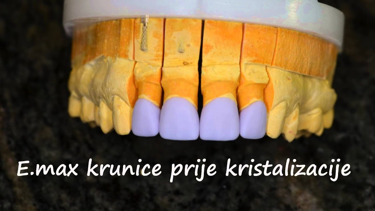 Navlake za zube - Krunice za zube - Zubne krunice  - Poliklinika Gikić