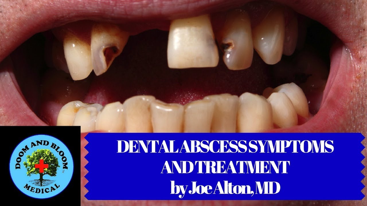 Dental Abscess Symptoms and Treatment in Survival