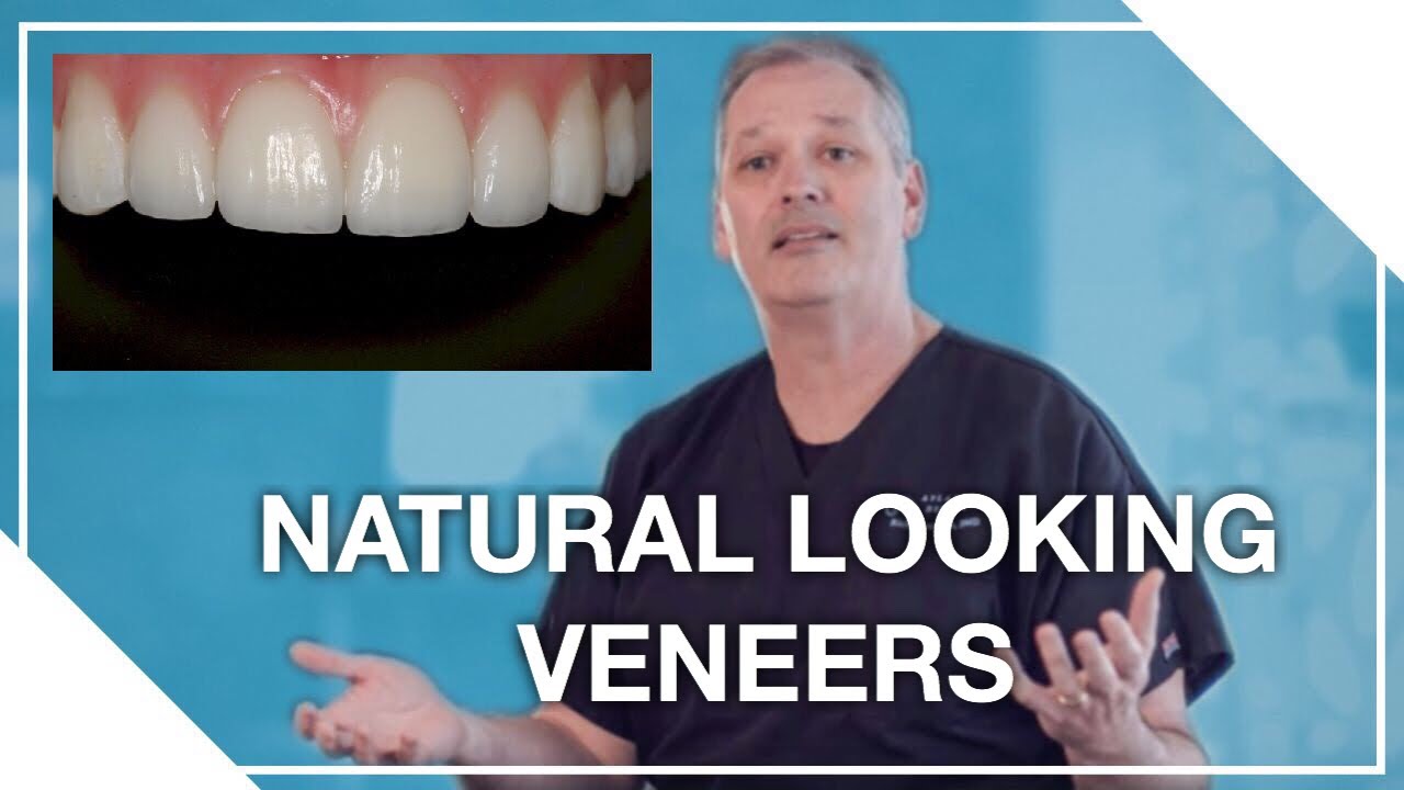 Natural Looking Veneers (Dr. Creasman)