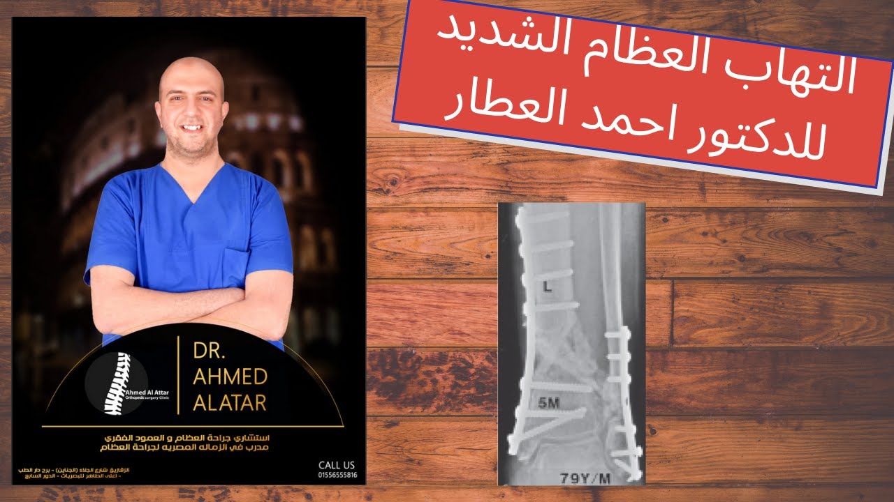 التهاب العظام الشديد للدكتور احمد العطار