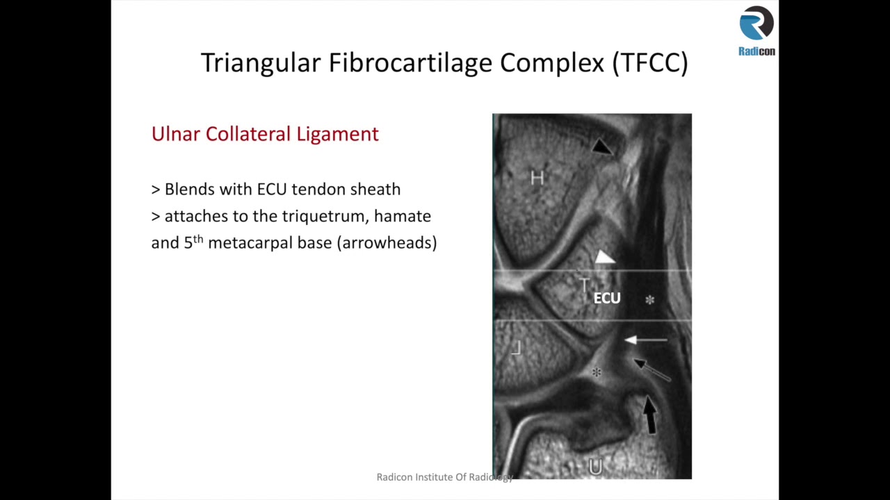 Wrist MRI Part 2: TFCC