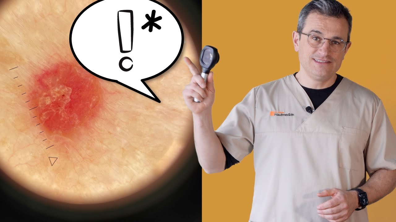 *Wer DAS bei sich entdeckt, muss zum Hautarzt (Verdacht auf hellen Hautkrebs). Dr. Kasten in Mainz