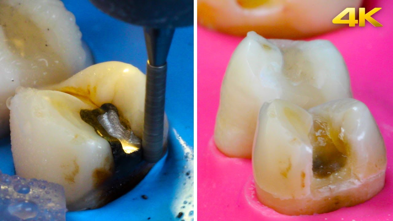 AWESOME Silver Filling Removal!