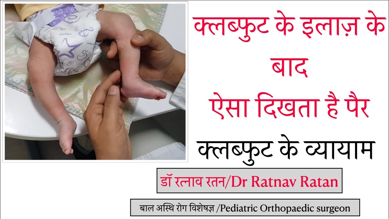 |क्लब्फुट के इलाज़ के बाद ऐसा दिखता है पैर|क्लब्फुट के व्यायाम|Clubfoot exercises|CLUBFOOT