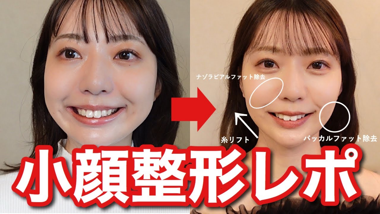 【整形しました】バッカルファット・ナゾラビアルファット除去と糸リフトの1ヶ月ダウンタイム経過密着レポ✨