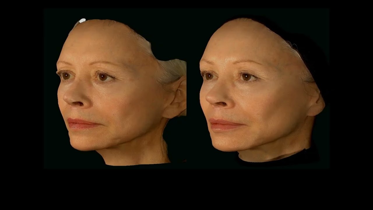 Dr M. Kuldeep – Concept de fusion : volume, contouring et perfection de la peau
