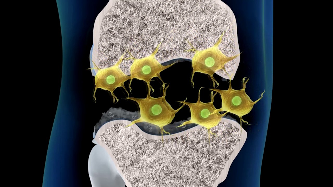 Experimental Stem Cell Therapy Could Treat Damaged Knee Cartilage