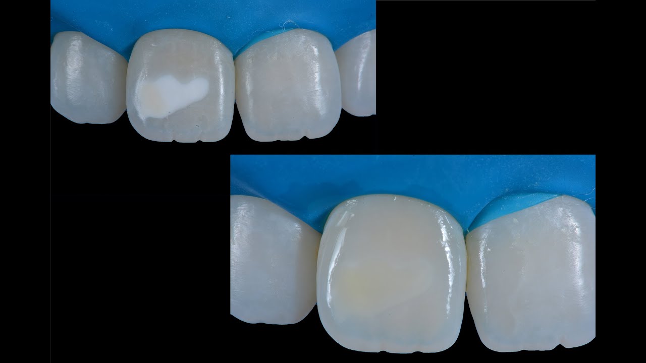 Remoção de Mancha Branca | White spot treatment using infiltration with Icon