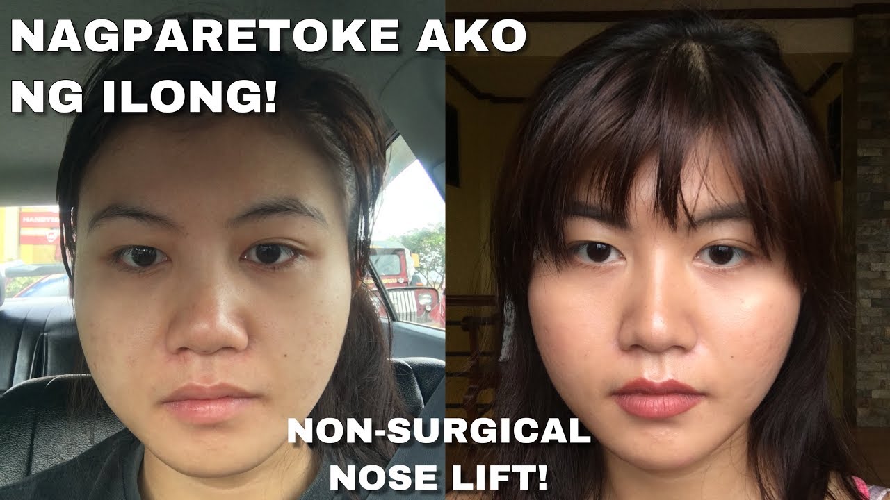 NON SURGICAL NOSE LIFT USING THREADS! RETOKADA!