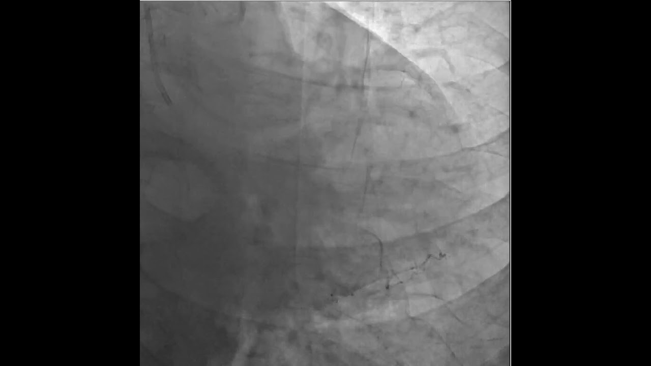 Left Anterior Coronary Artery Chronic Complete Ostial Occlusion