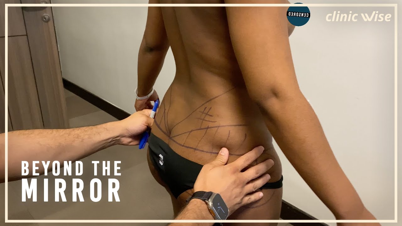 Nyasha' Experience | SAFE BBL & LIPOSUCTION | Beyond the Mirror (Episode 16)