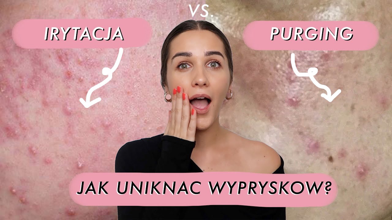 PURGING vs IRRITATION of skin after RETINOL | How to get rid of acne?
