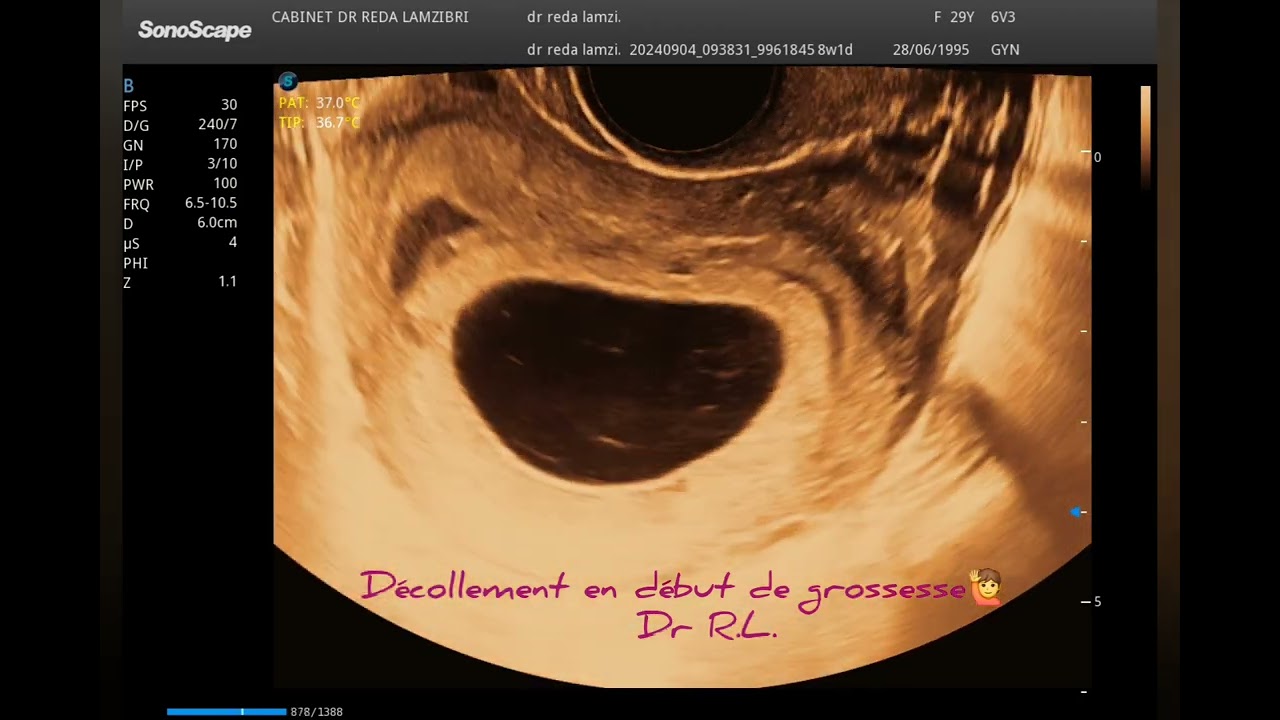 🤔 voici quelques explications sur le décollement en début de grossesse ⁉️