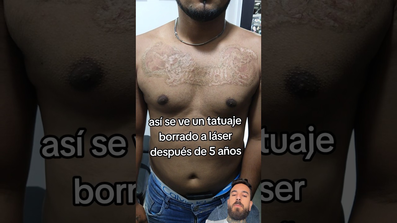 Se BORR&Oacute; su TATUAJE con L&Aacute;SER y AS&Iacute; QUED&Oacute; 😖💀