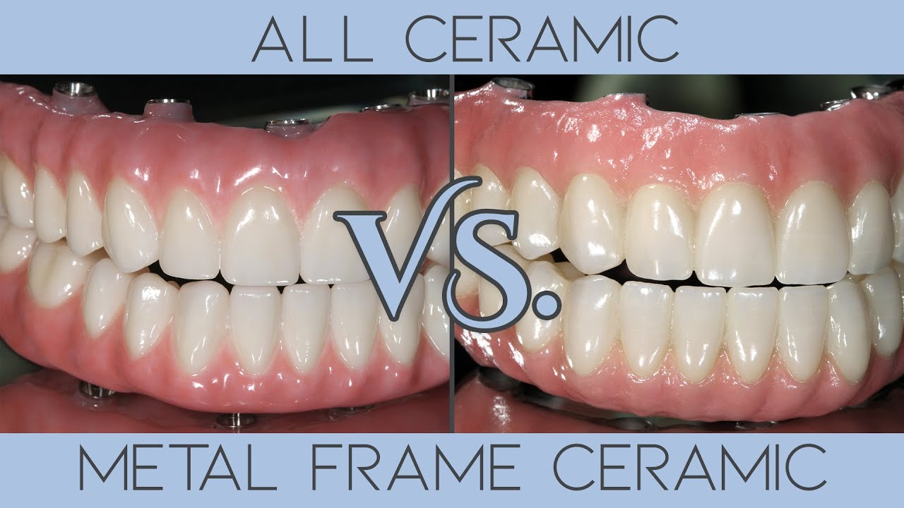 All Ceramic Dentures VS Metal Frame With Ceramic Exterior
