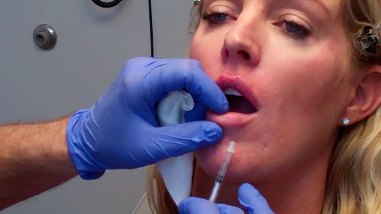 The Micro-Injection Technique for Beautiful Lips