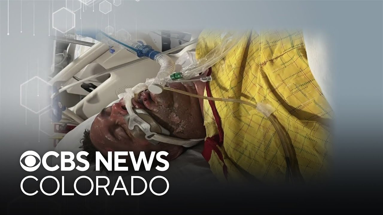 Rancher in Colorado recalls day when he was burned in an explosion