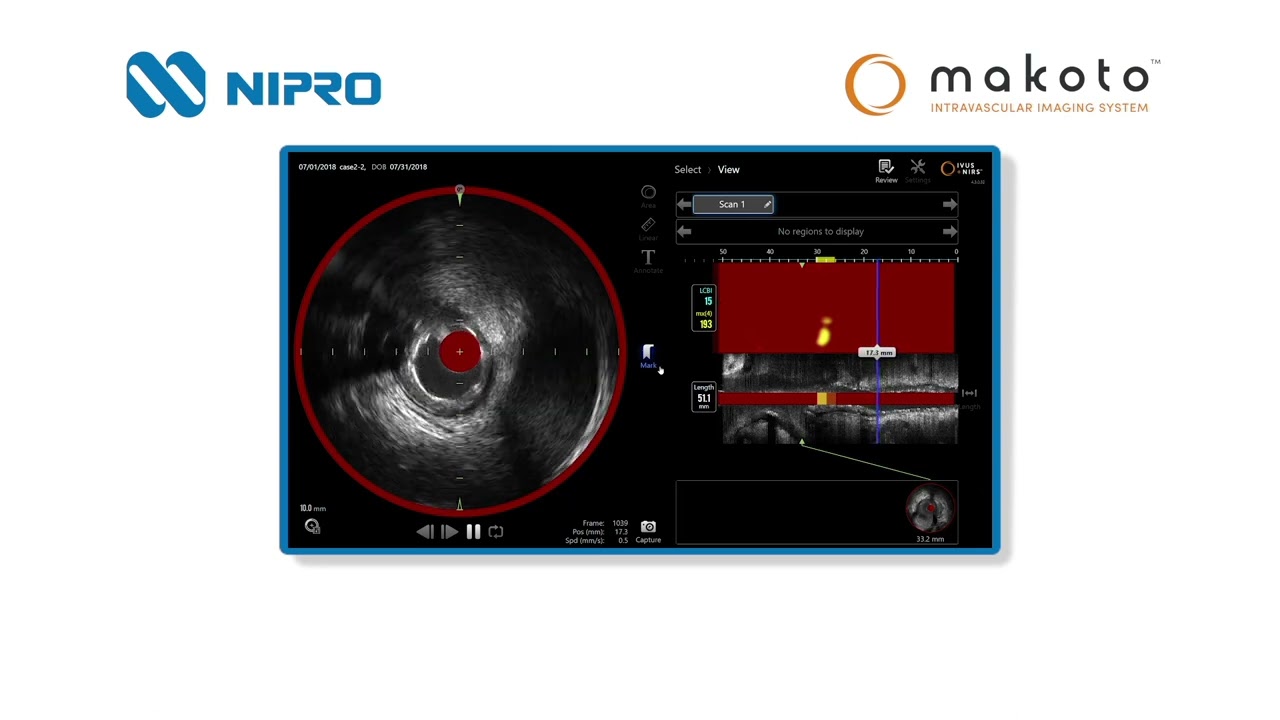 Makoto™ Intravascular Imaging System - Makoto Pullback #2 - Nipro Vascular Division