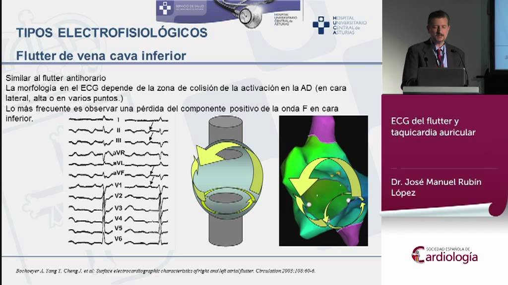 ECG del flutter y taquicardia auricular