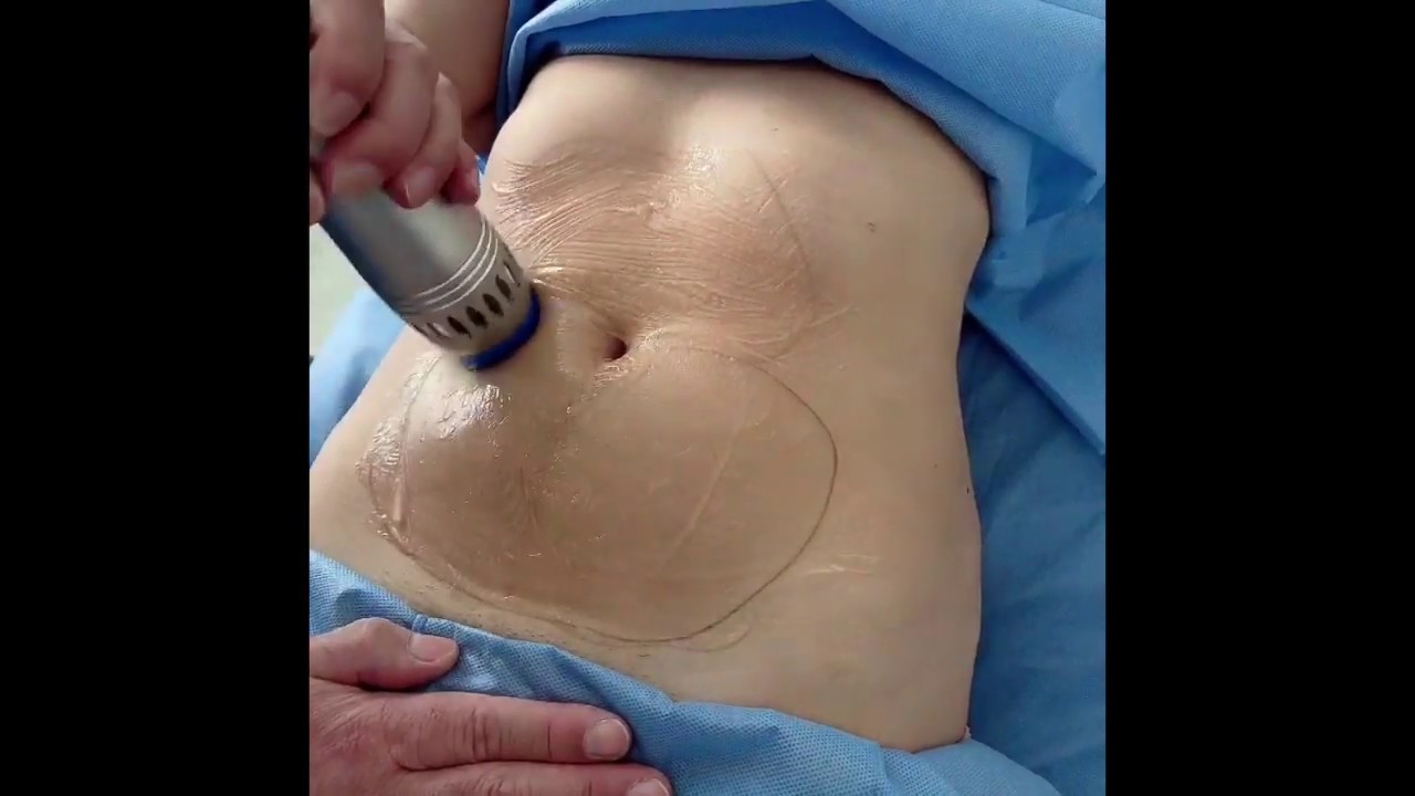 Ondas de choque para manejo de grasa corporal