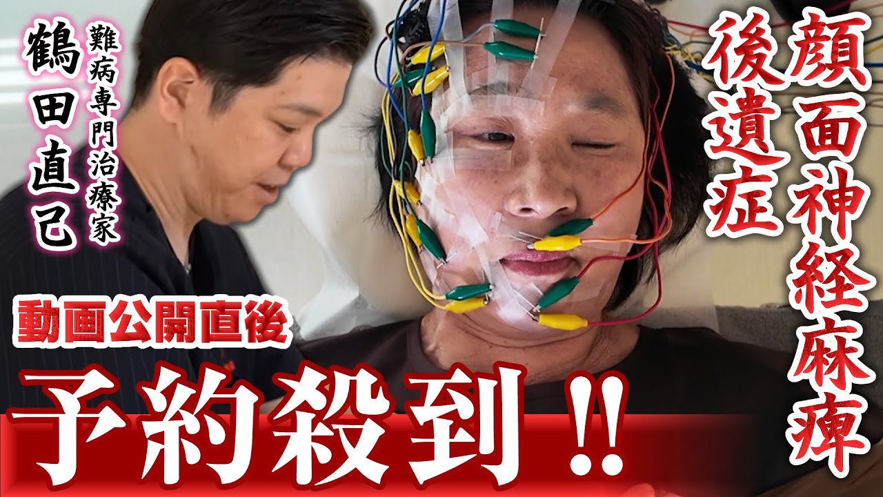 【顔面神経麻痺】医師も救えない後遺症「目が閉じれない・口が閉まらない・笑えない」プツリと切れた神経が変な動きをしてしまうことが原因。後遺症でお悩みの方は是非ご覧ください。