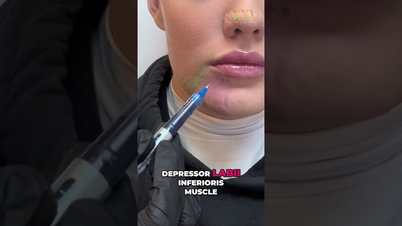 How to get balanced results using DAO (Depressor Anguli Oris) correction techniques.