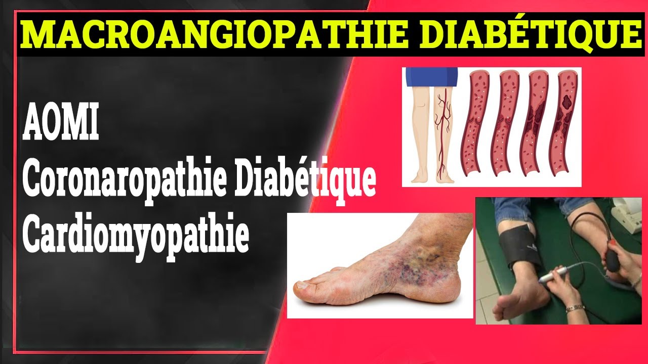Complications Chroniques du Diabète: MACROANGIOPATHIE DIABÉTIQUE | Endocrinologie Medicale