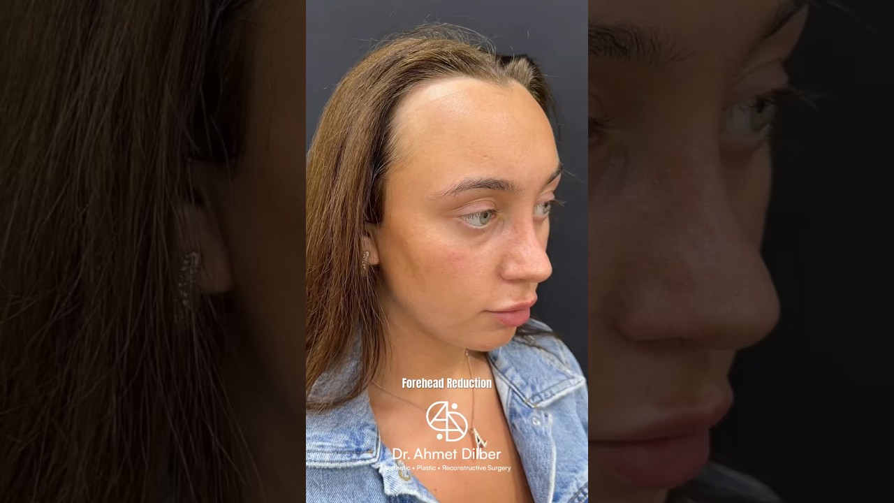 FOREHEAD REDUCTION 💆🏻&zwj;♀️ Dr. Ahmet Dilber 🪄 #foreheadreduction #alındaraltma #plasticsurgery