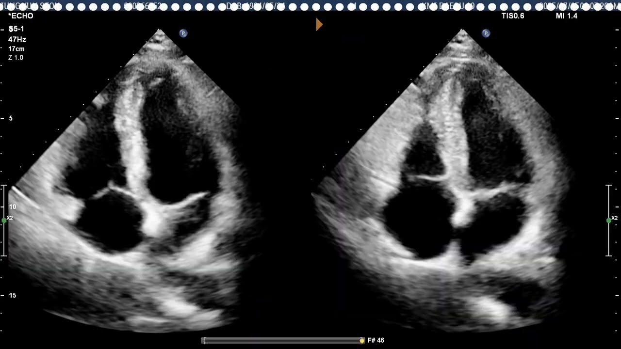 [Echo Case Review]R/O Ebstein anomaly , RV dilatation