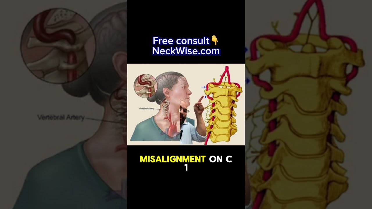 vertebrobasilar insufficiency and the neck connection |  upper cervical chiropractic for Myers