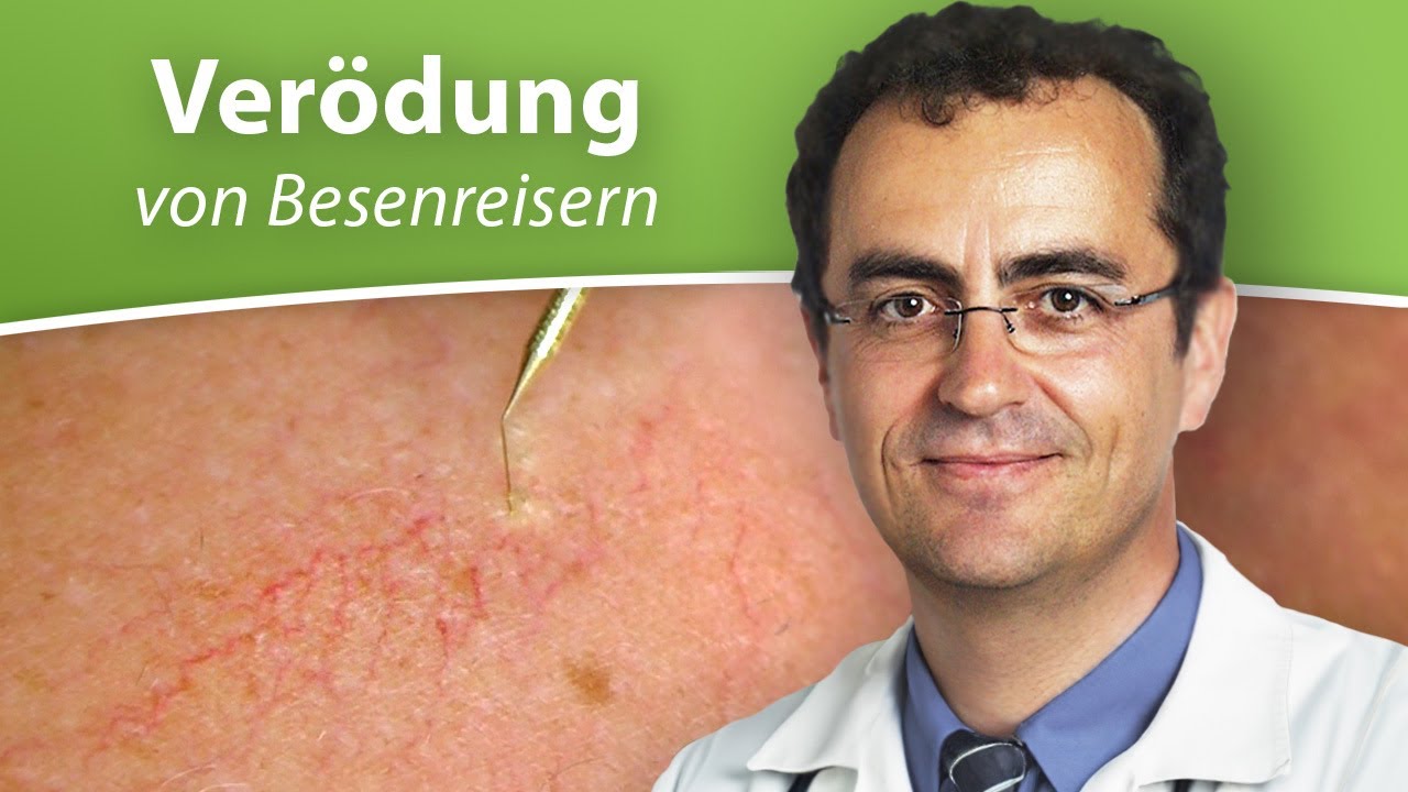 Besenreiser entfernen und der wichtige Unterschied zu Krampfadern - Phlebologe über die Phlebolyse