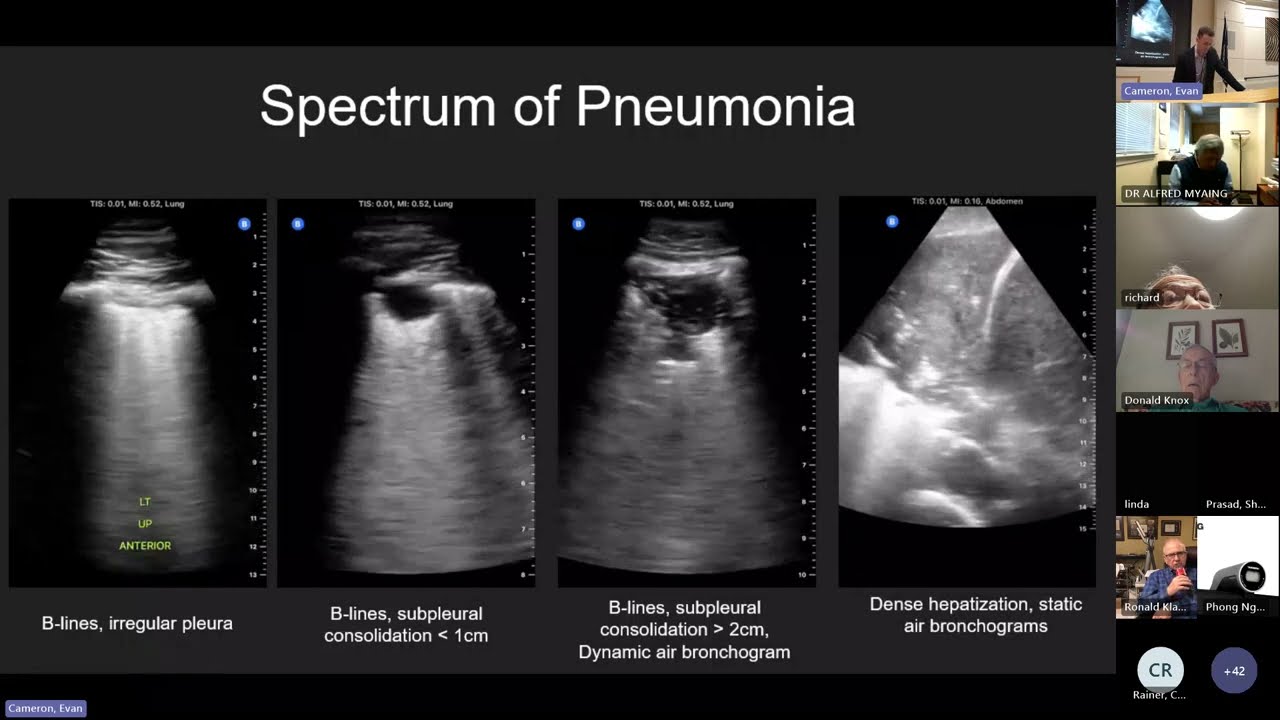 Diagnosing Pneumonia at the Bedside with Point-of-care Ultrasound (POCUS) - Dr. Larry Istrail