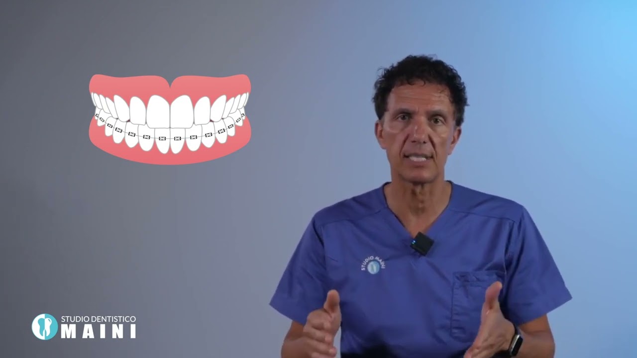 Quale apparecchio dentale?