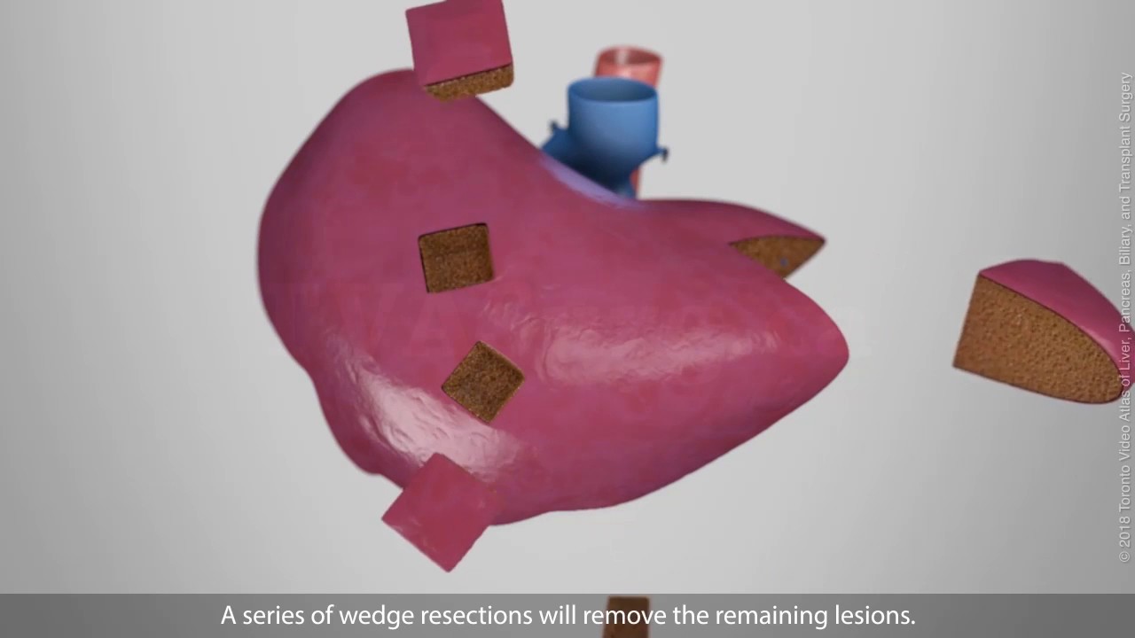 Extended right hepatectomy with multiple wedge resections
