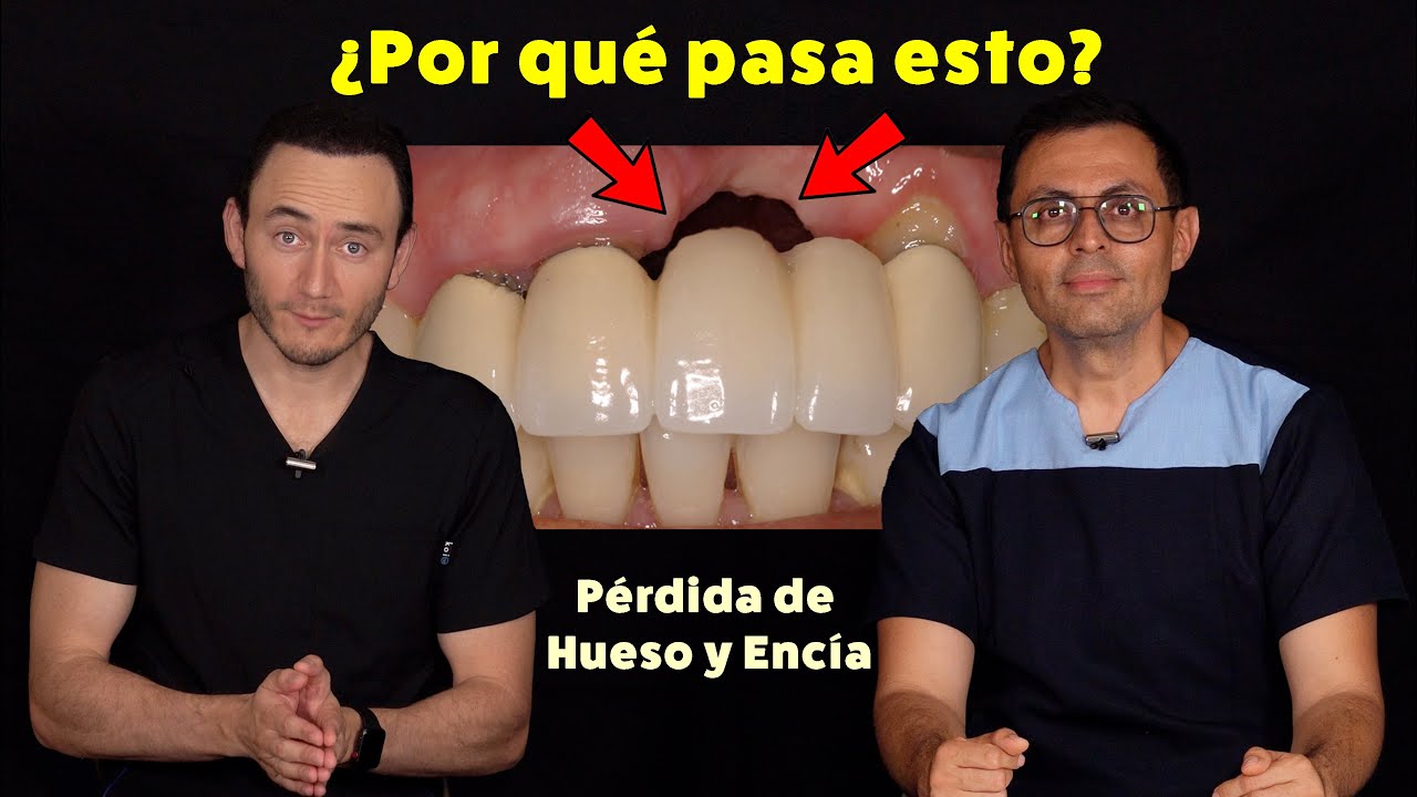 ¿Cómo evitar la retracción de encía y hueso después de una Extracción Dental?