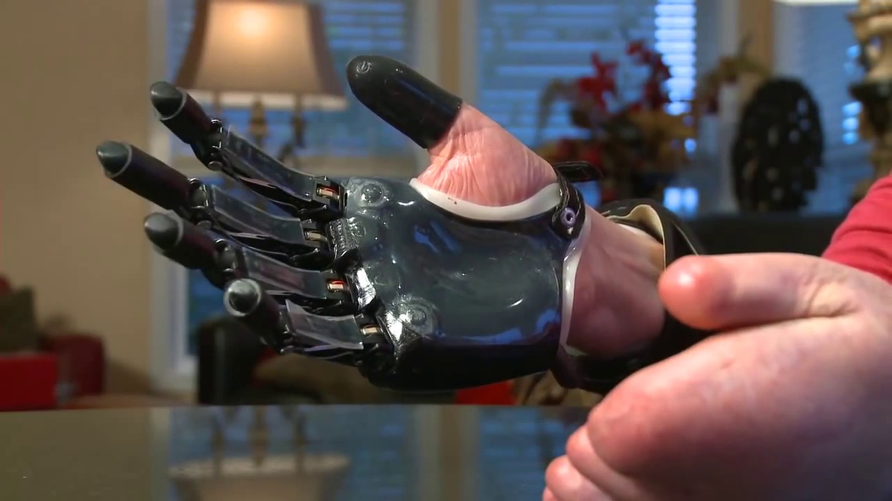 Electric Fingers Give Hope to Bilateral Amputee