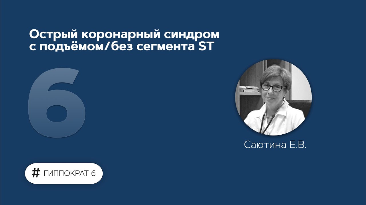 Острый коронарный синдром с подъёмом/без сегмента ST 13.02.23