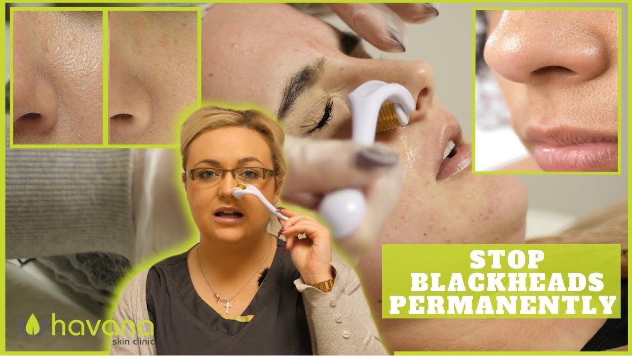 Derma Rolling Large Pores