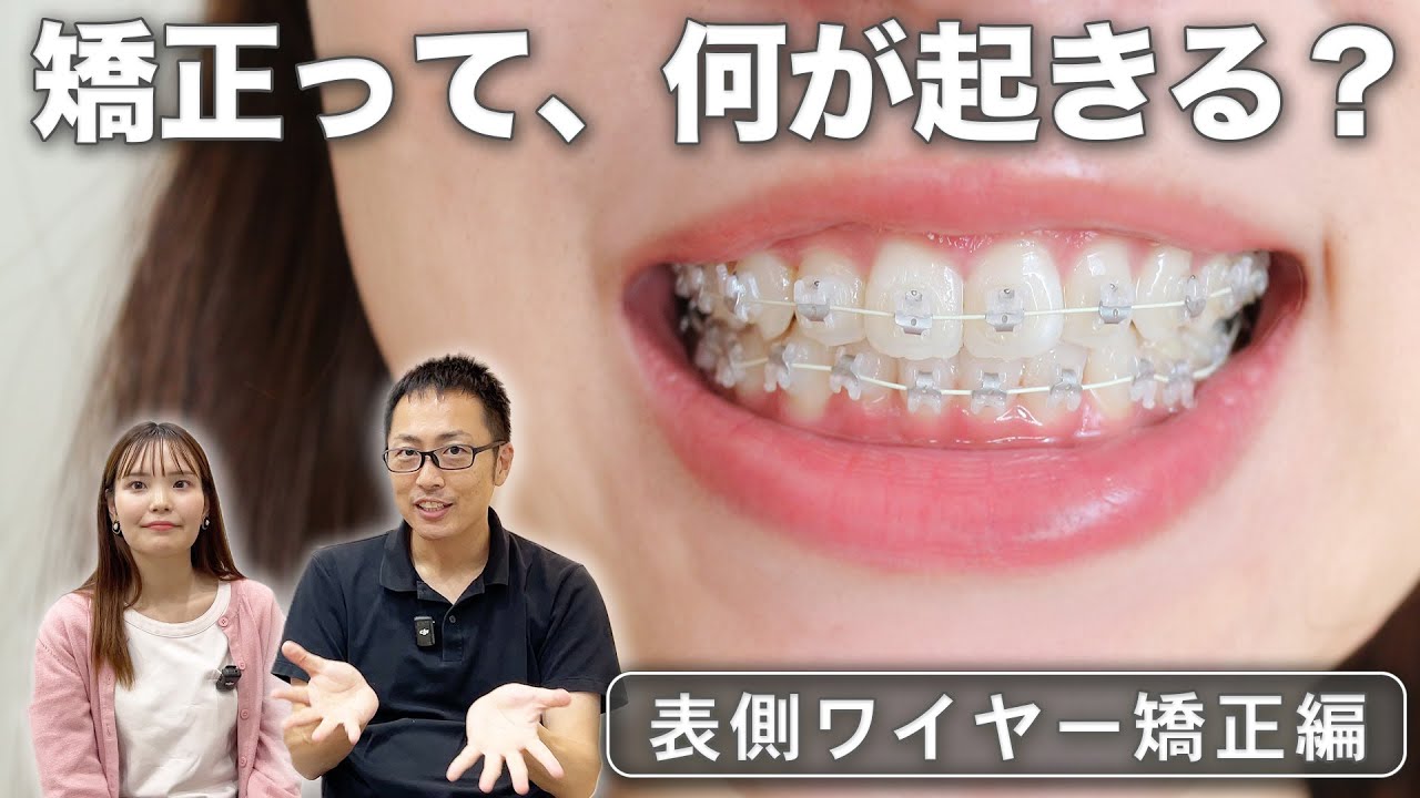 【表側ワイヤー矯正】矯正の流れ！６つの工程と注意点を解説します