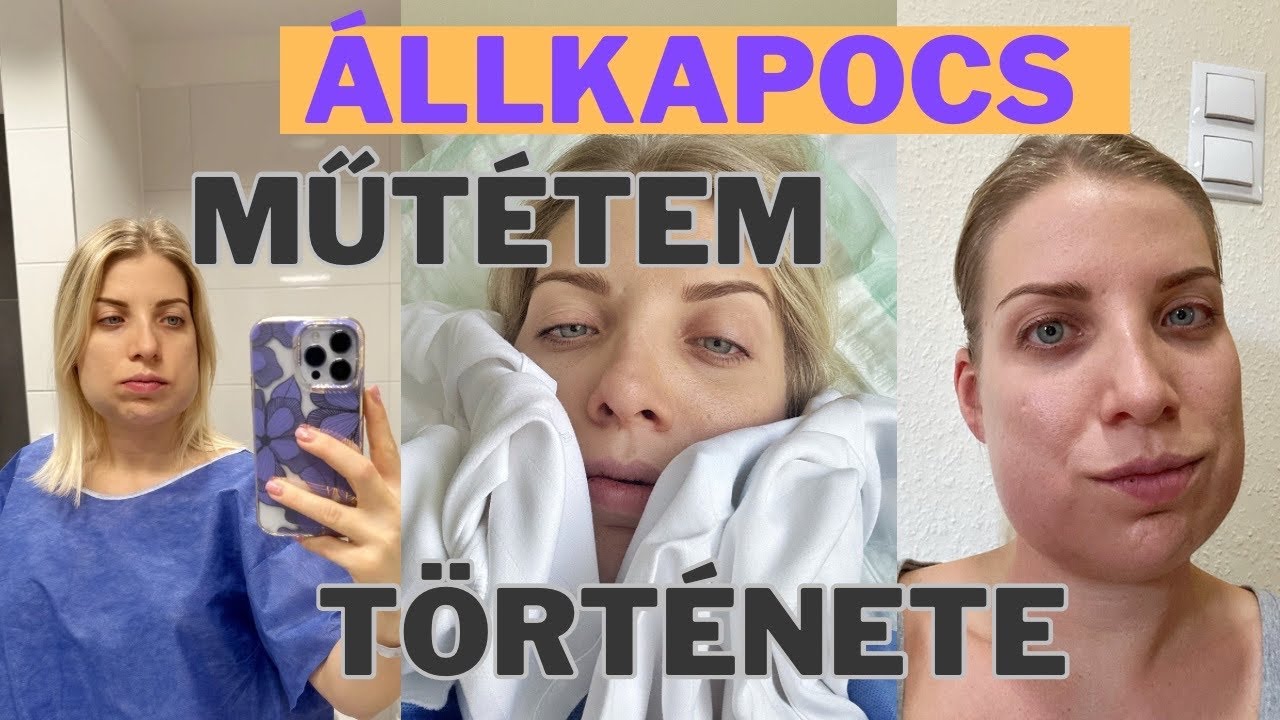 Állkapocs Műtét | Előtte és Utána