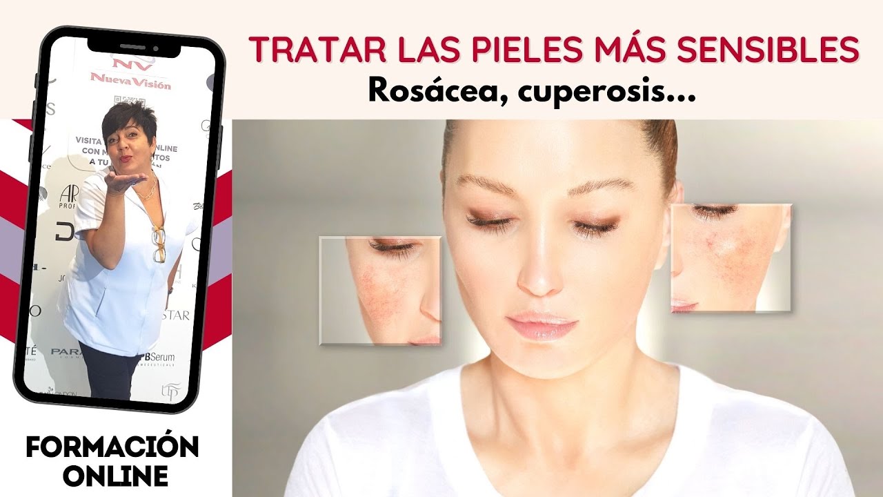 Cómo tratar las pieles más sensibles: Rosácea, Cuperosis...
