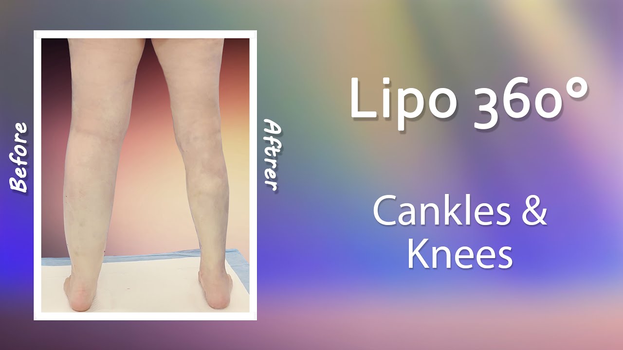 Leg Liposuction Results | Lipo 360&deg; Cankles & Knees | High-Definition | Expert Dr. Thomas Su