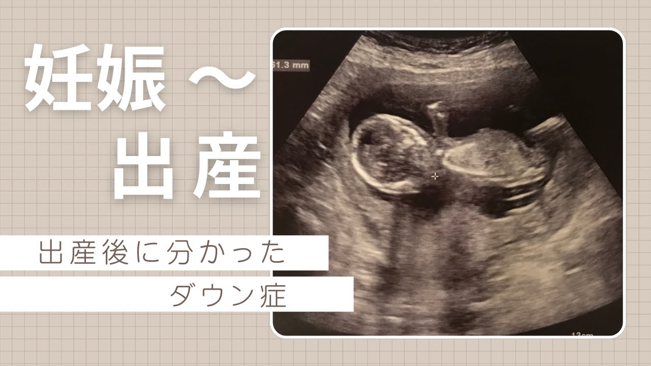 出産後に分かったダウン症