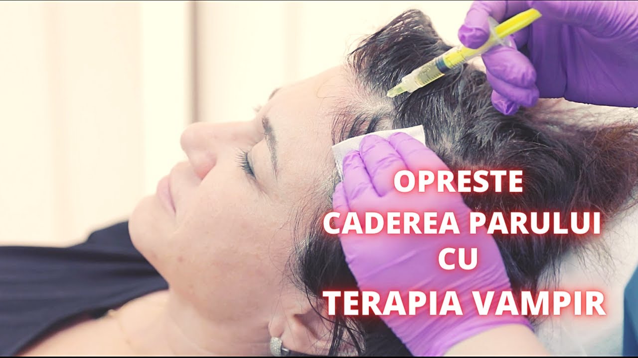 Opreste Alopecia (caderea parului) prin intermediul Terapiei Vampir