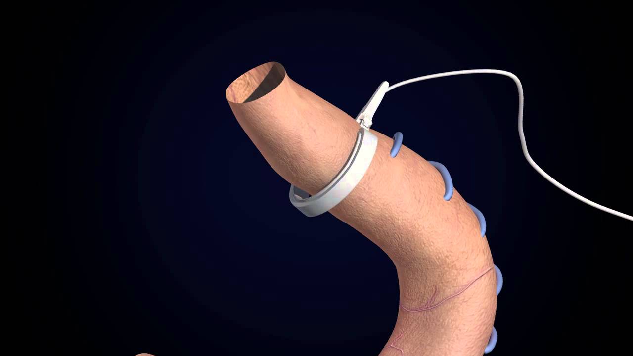 Laparoscopic adjustable gastric banded plication