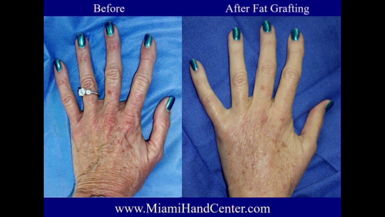 Hand Rejuvenation: Before and After