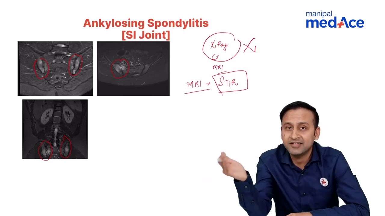 Understanding Ankylosing Spondylitis : Radiology Lecture by Dr. Abhishek Jha | Manipal Medace