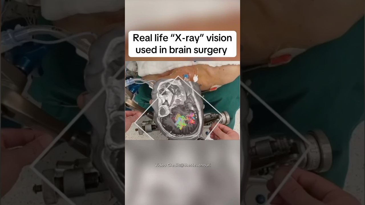 AI and AR combined #Medical #Medtok #Surgery #Surgeon #AR #AI